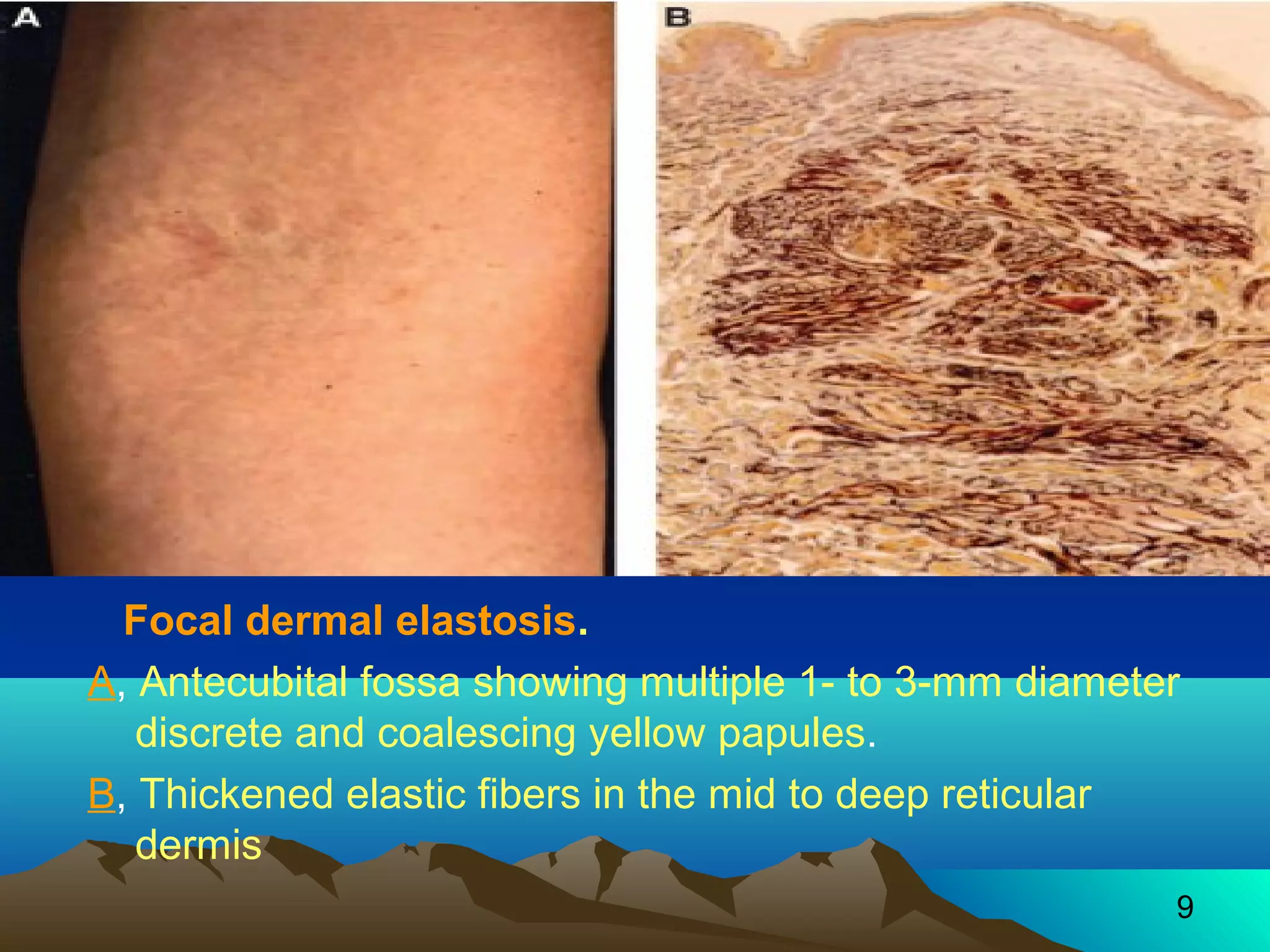 Focal dermal elastosis. 
A, Antecubital fossa showing multiple 1- to 3-mm diameter 
discrete and coalescing yellow papules. 
B, Thickened elastic fibers in the mid to deep reticular 
dermis 
9 
 