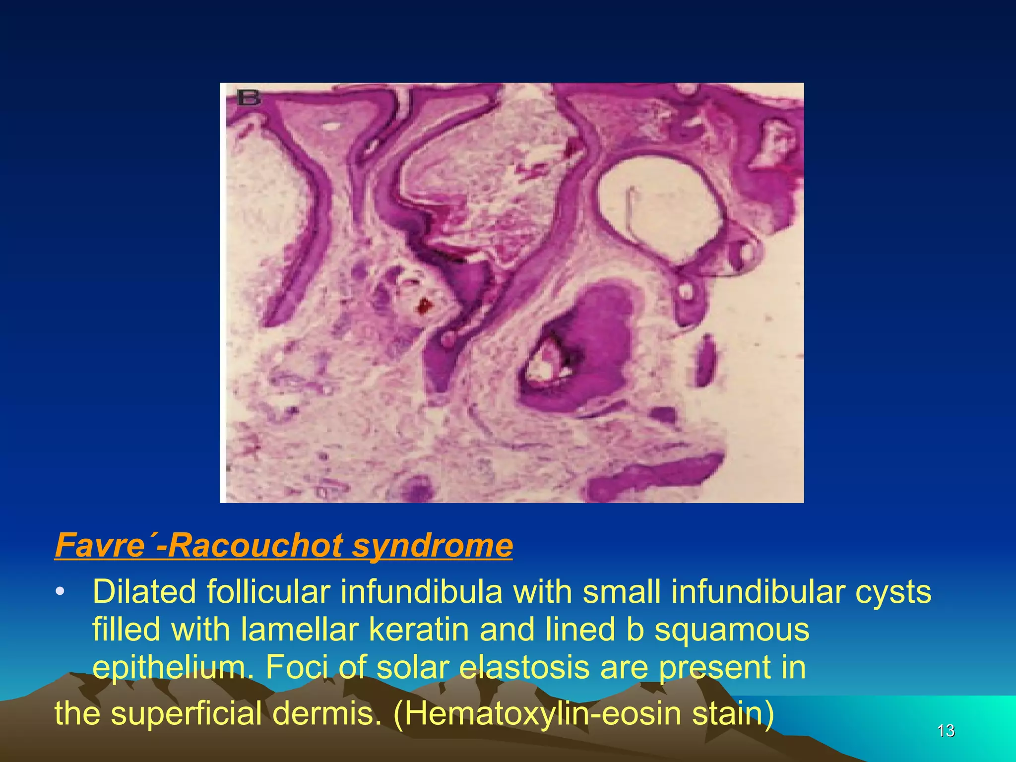 Favre´-Racouchot syndrome Dilated follicular infundibula with small infundibular cysts filled with lamellar keratin and lined b squamous epithelium. Foci of solar elastosis are present in the superficial dermis. (Hematoxylin-eosin stain) 