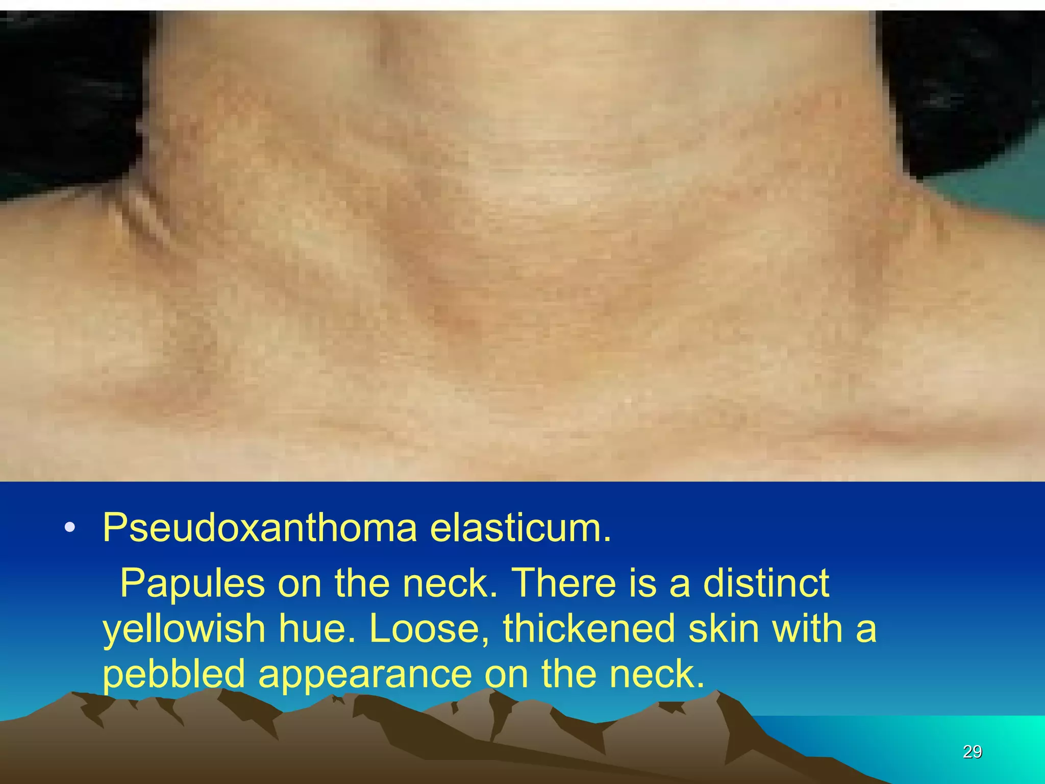 Pseudoxanthoma elasticum. Papules on the neck. There is a distinct yellowish hue. Loose, thickened skin with a pebbled appearance on the neck. 