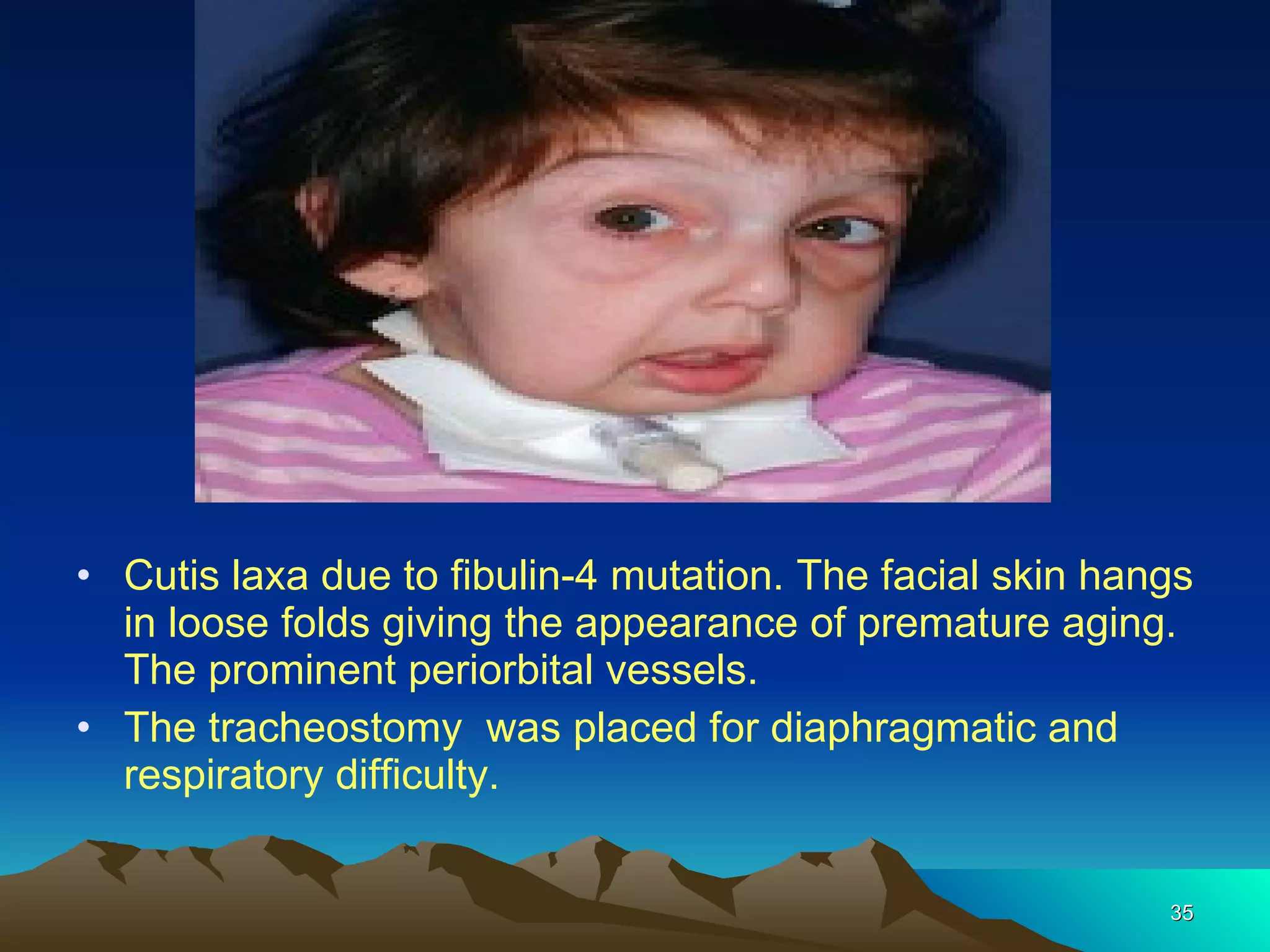 Cutis laxa due to fibulin-4 mutation. The facial skin hangs in loose folds giving the appearance of premature aging. The prominent periorbital vessels.  The tracheostomy  was placed for diaphragmatic and respiratory difficulty. 