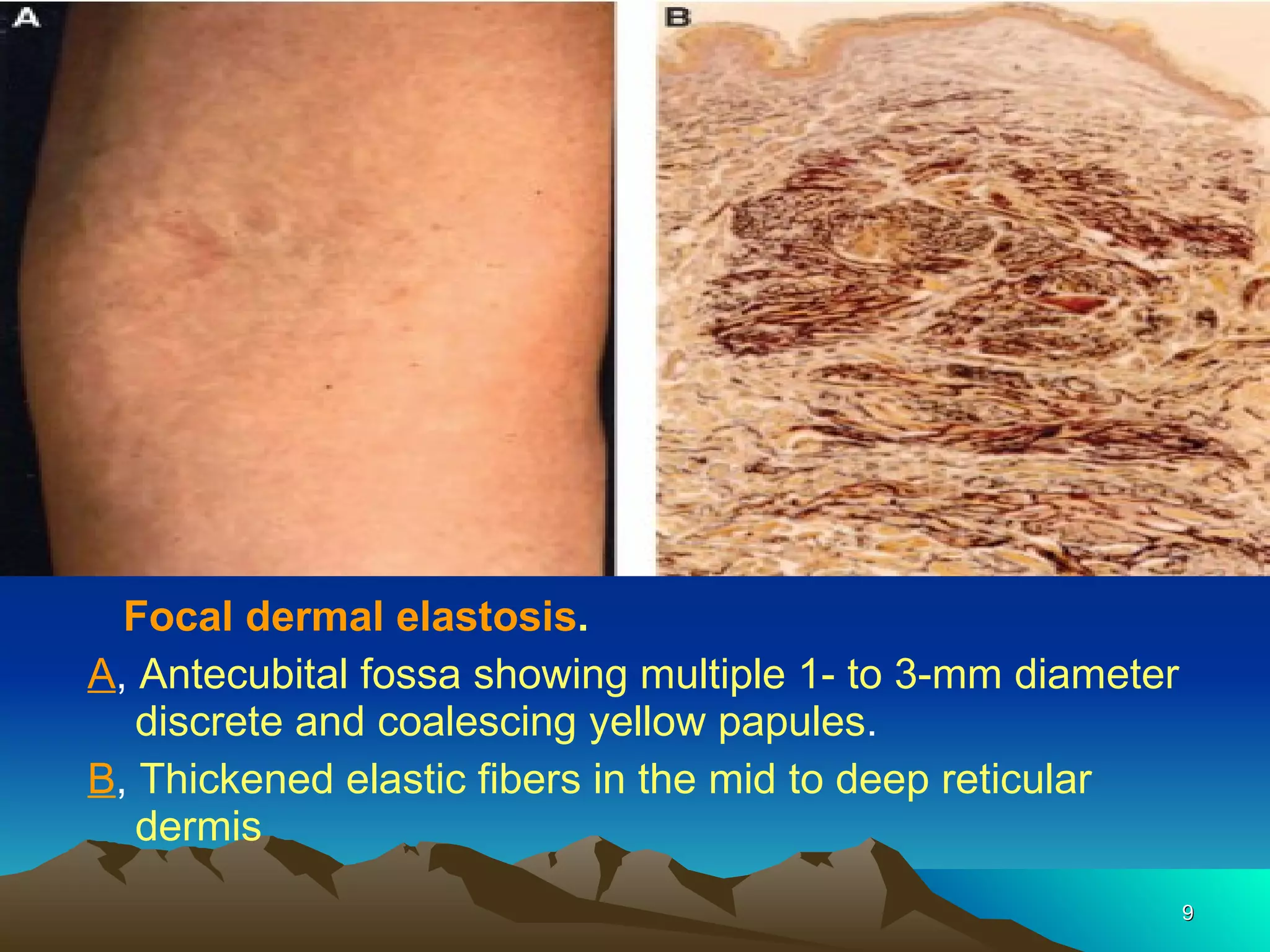 Focal dermal elastosis .   A ,  Antecubital fossa showing multiple 1- to 3-mm diameter  discrete and coalescing yellow papules .  B ,  Thickened elastic fibers in the mid to deep reticular dermis 