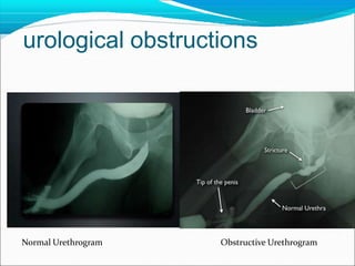 Normal Urethrogram Obstructive Urethrogram
urological obstructions
 