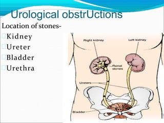 Urological obstrUctions
Location of stones-
Kidney
Ureter
Bladder
Urethra
 