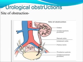 Urological obstrUctions
Site of obstruction-
 