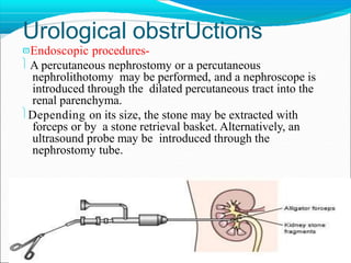 Urological obstrUctions
Endoscopic procedures-
 A percutaneous nephrostomy or a percutaneous
nephrolithotomy may be performed, and a nephroscope is
introduced through the dilated percutaneous tract into the
renal parenchyma.
Depending on its size, the stone may be extracted with
forceps or by a stone retrieval basket. Alternatively, an
ultrasound probe may be introduced through the
nephrostomy tube.
 