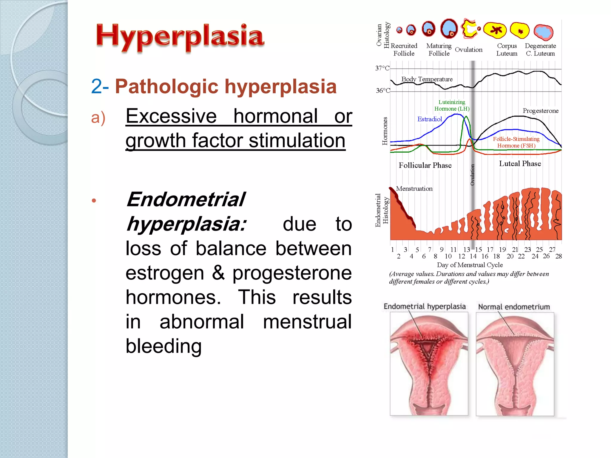 2- Pathologic hyperplasia
a) Excessive hormonal or
growth factor stimulation
•

Endometrial
hyperplasia:

due to
loss of balance between
estrogen & progesterone
hormones. This results
in abnormal menstrual
bleeding

 