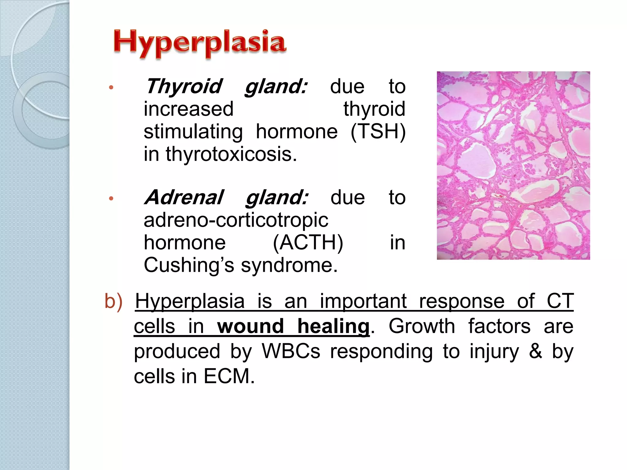 •

Thyroid

gland:

•

Adrenal

gland:

due to
increased
thyroid
stimulating hormone (TSH)
in thyrotoxicosis.
due

adreno-corticotropic
hormone
(ACTH)
Cushing’s syndrome.

to

in

b) Hyperplasia is an important response of CT
cells in wound healing. Growth factors are
produced by WBCs responding to injury & by
cells in ECM.

 