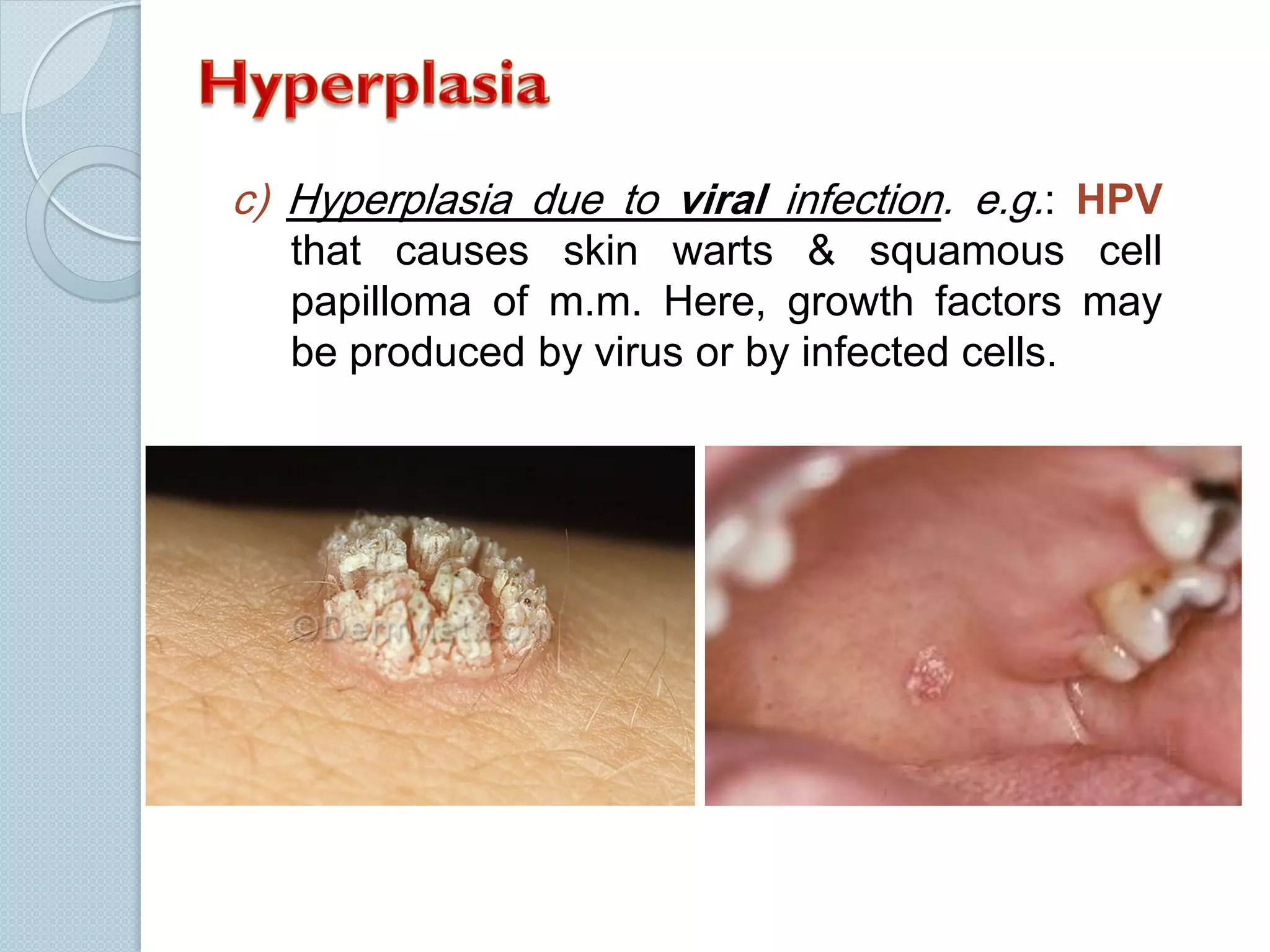 c) Hyperplasia due to viral infection. e.g.: HPV
that causes skin warts & squamous cell
papilloma of m.m. Here, growth factors may
be produced by virus or by infected cells.

 