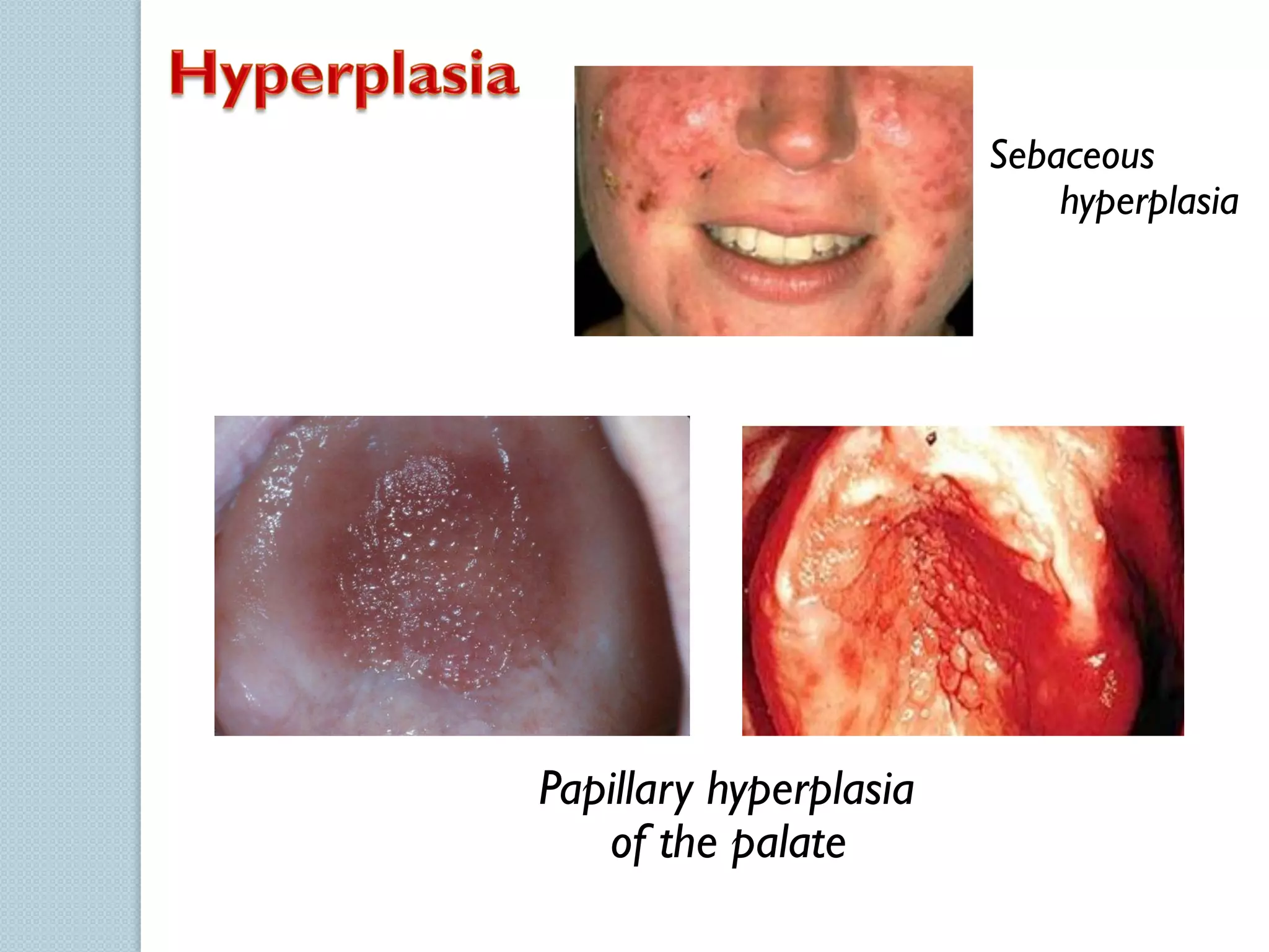 Sebaceous
hyperplasia

Papillary hyperplasia
of the palate

 