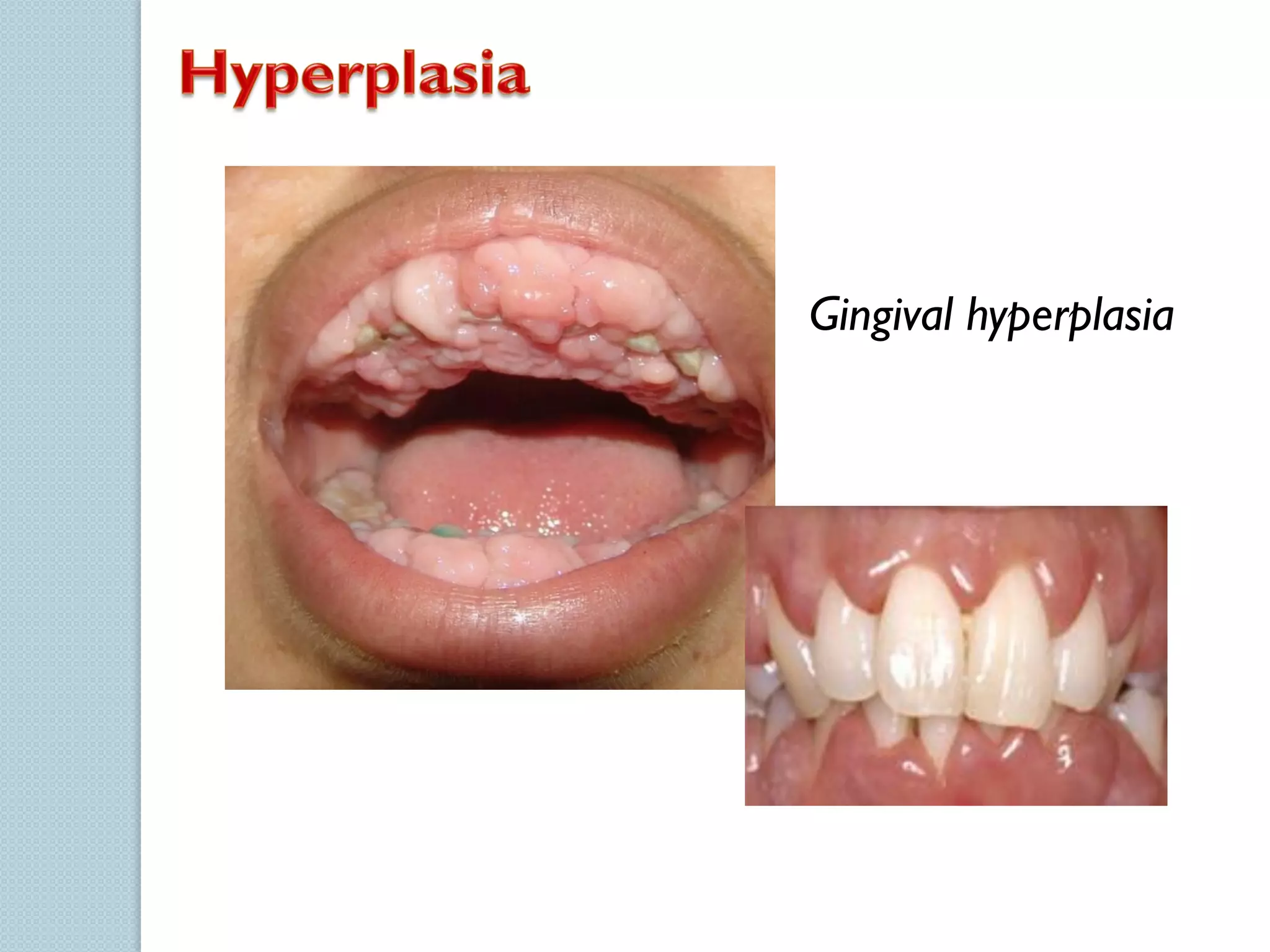 Gingival hyperplasia

 