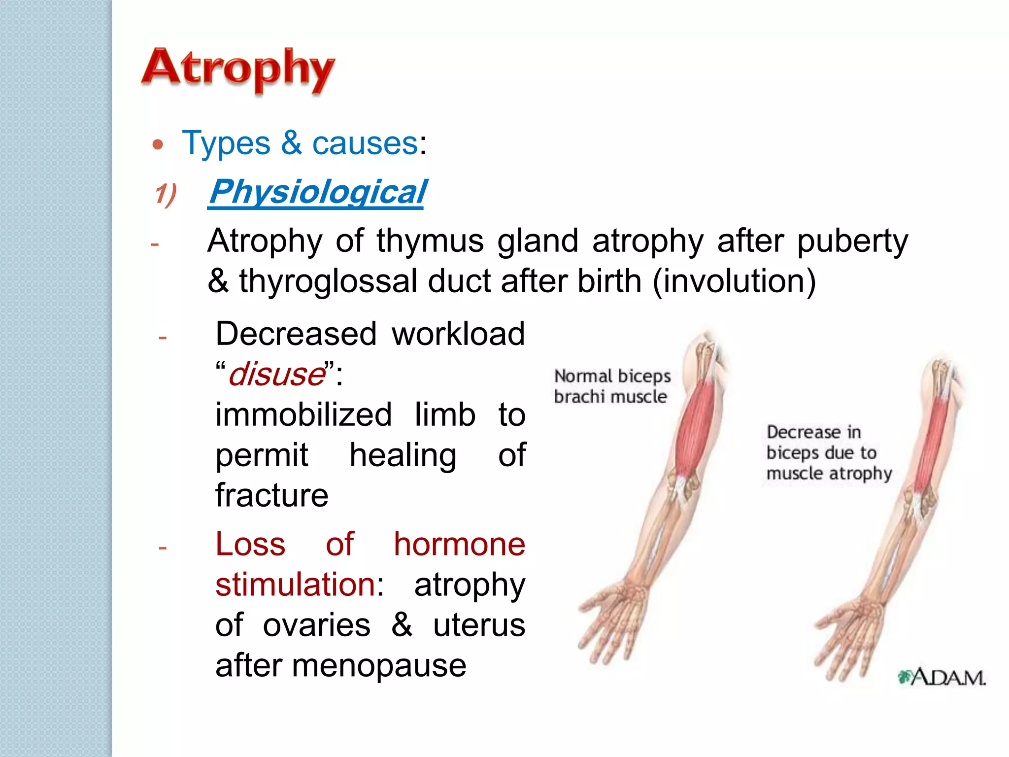 

Types & causes:

1)

Physiological

-

Atrophy of thymus gland atrophy after puberty
& thyroglossal duct after birth (involution)

-

Decreased workload
“disuse”:
immobilized limb to
permit healing of
fracture
Loss of hormone
stimulation: atrophy
of ovaries & uterus
after menopause

-

 
