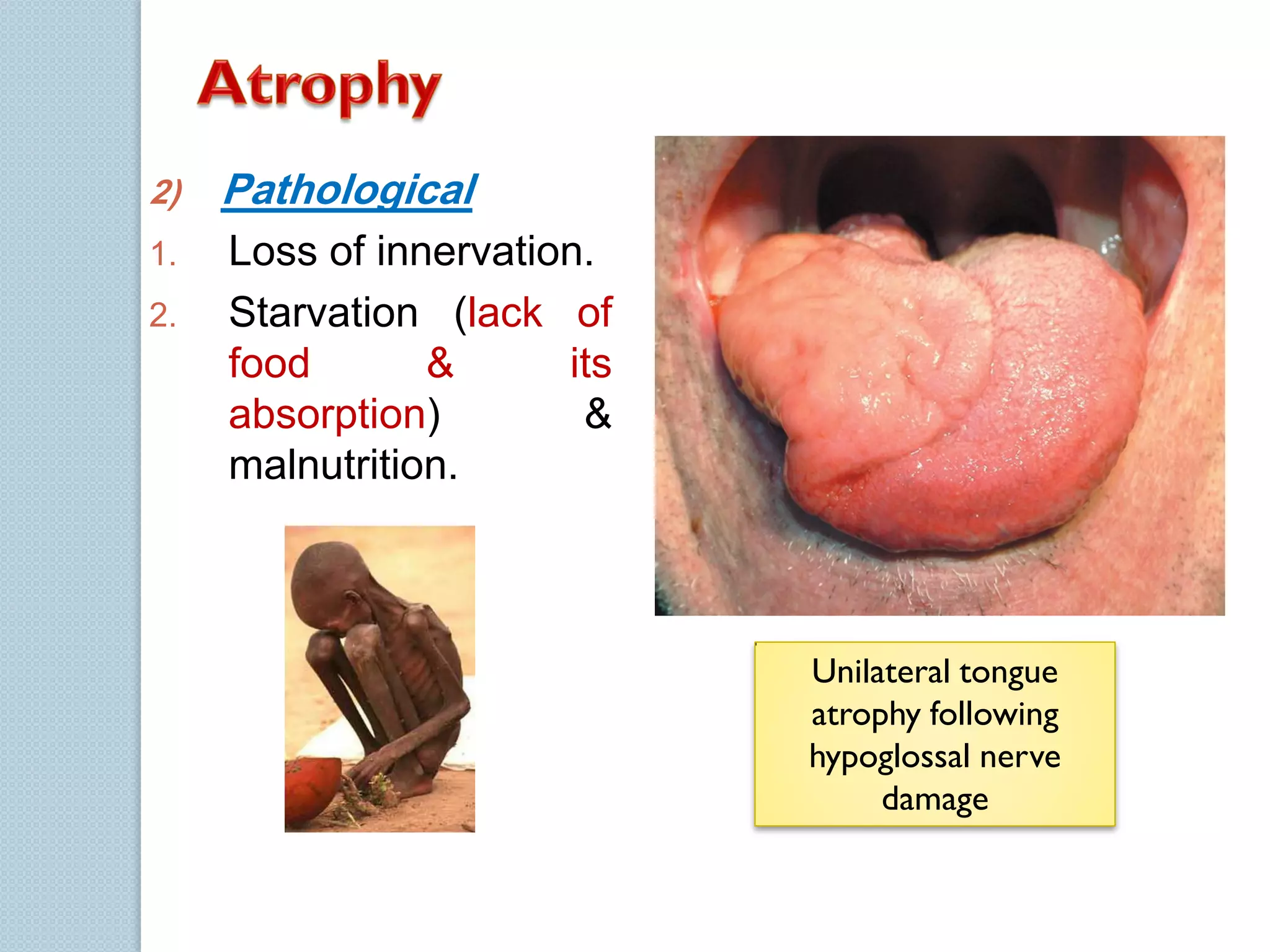 2)

Pathological

1.

Loss of innervation.
Starvation (lack of
food
&
its
absorption)
&
malnutrition.

2.

Unilateral tongue
atrophy following
hypoglossal nerve
damage

 