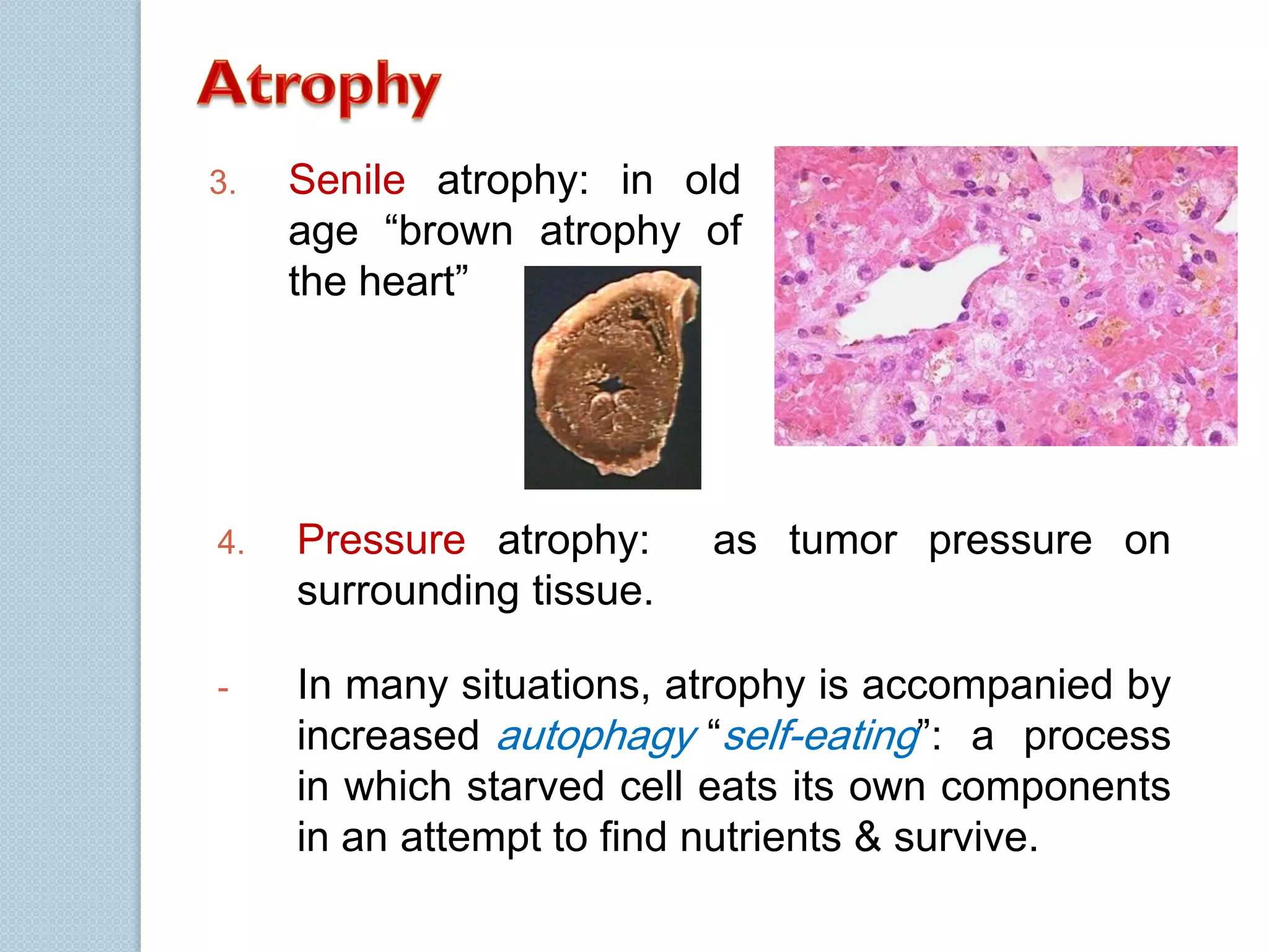 3.

Senile atrophy: in old
age “brown atrophy of
the heart”

4.

Pressure atrophy:
surrounding tissue.

-

In many situations, atrophy is accompanied by
increased autophagy “self-eating”: a process
in which starved cell eats its own components
in an attempt to find nutrients & survive.

as tumor pressure on

 