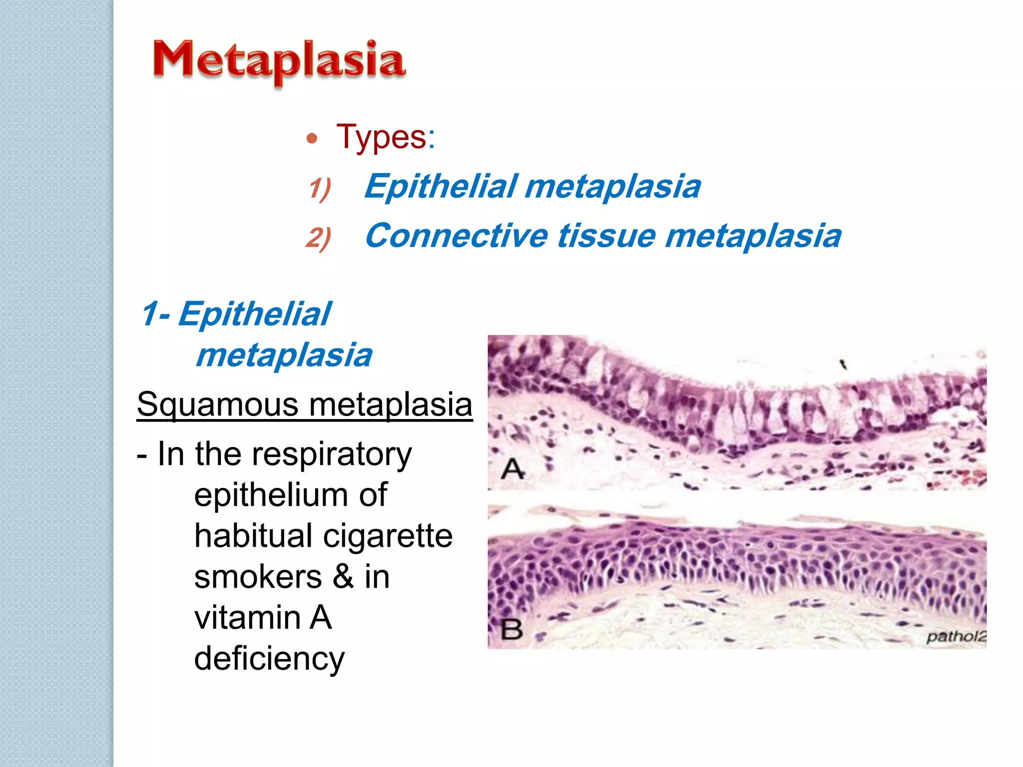 

1)
2)

Types:

Epithelial metaplasia
Connective tissue metaplasia

1- Epithelial
metaplasia
Squamous metaplasia
- In the respiratory
epithelium of
habitual cigarette
smokers & in
vitamin A
deficiency

 