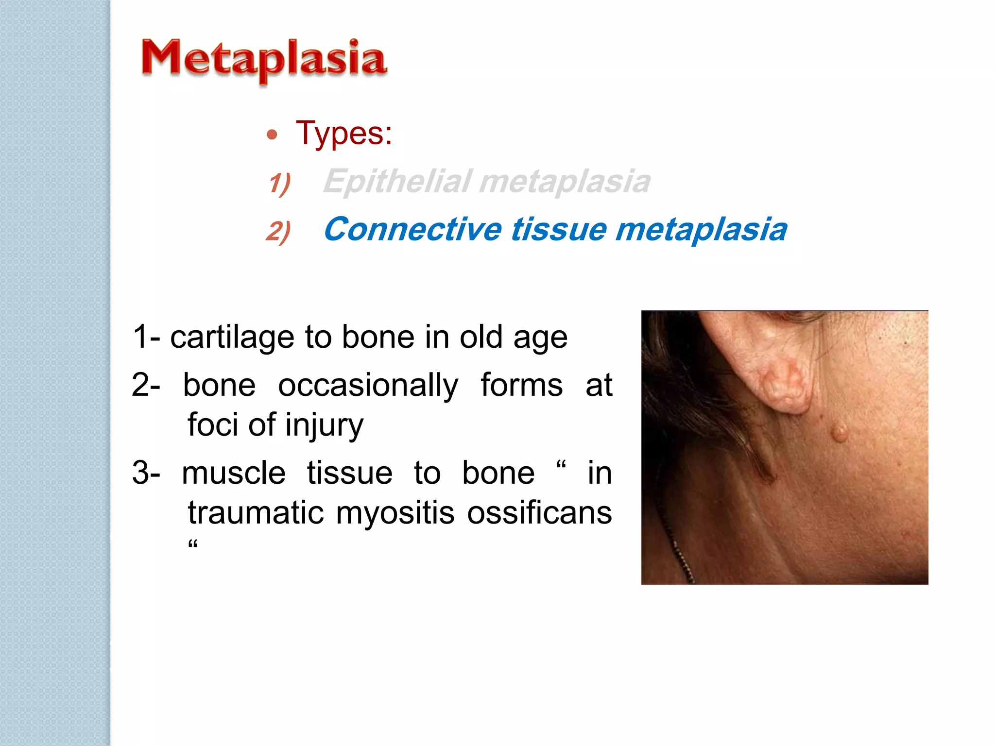 

1)
2)

Types:

Epithelial metaplasia
Connective tissue metaplasia

1- cartilage to bone in old age
2- bone occasionally forms at
foci of injury
3- muscle tissue to bone “ in
traumatic myositis ossificans
“

 
