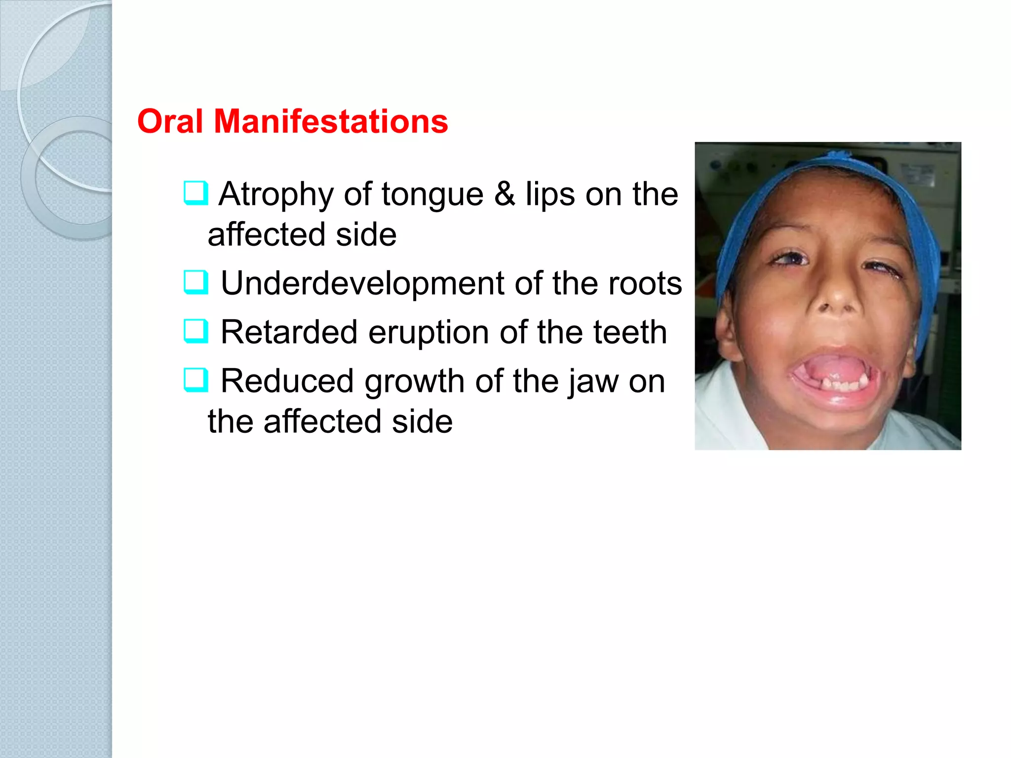 Oral Manifestations
 Atrophy of tongue & lips on the
affected side
 Underdevelopment of the roots
 Retarded eruption of the teeth
 Reduced growth of the jaw on
the affected side

 