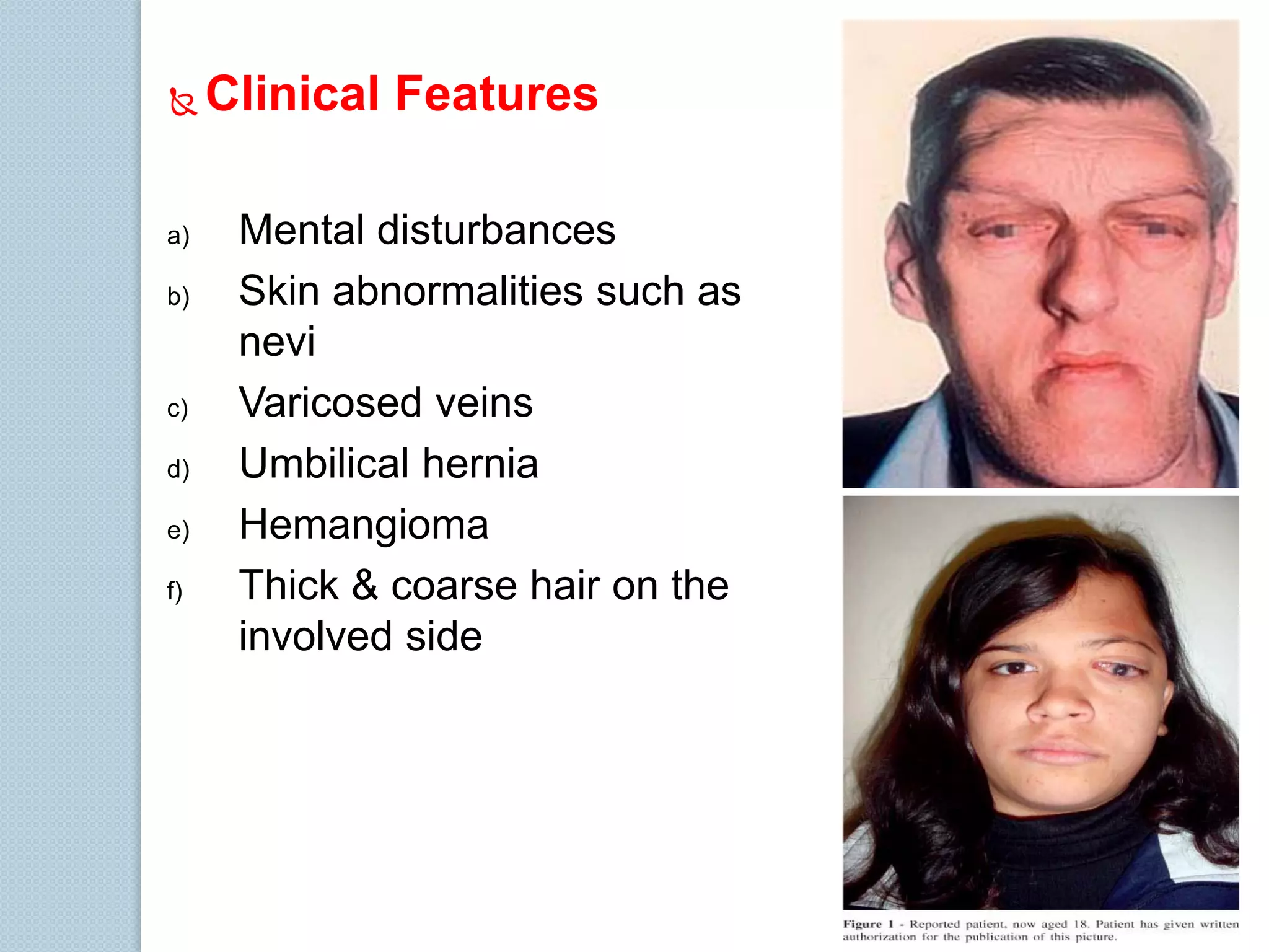 

a)
b)

c)

d)
e)
f)

Clinical Features
Mental disturbances
Skin abnormalities such as
nevi
Varicosed veins
Umbilical hernia
Hemangioma
Thick & coarse hair on the
involved side

 