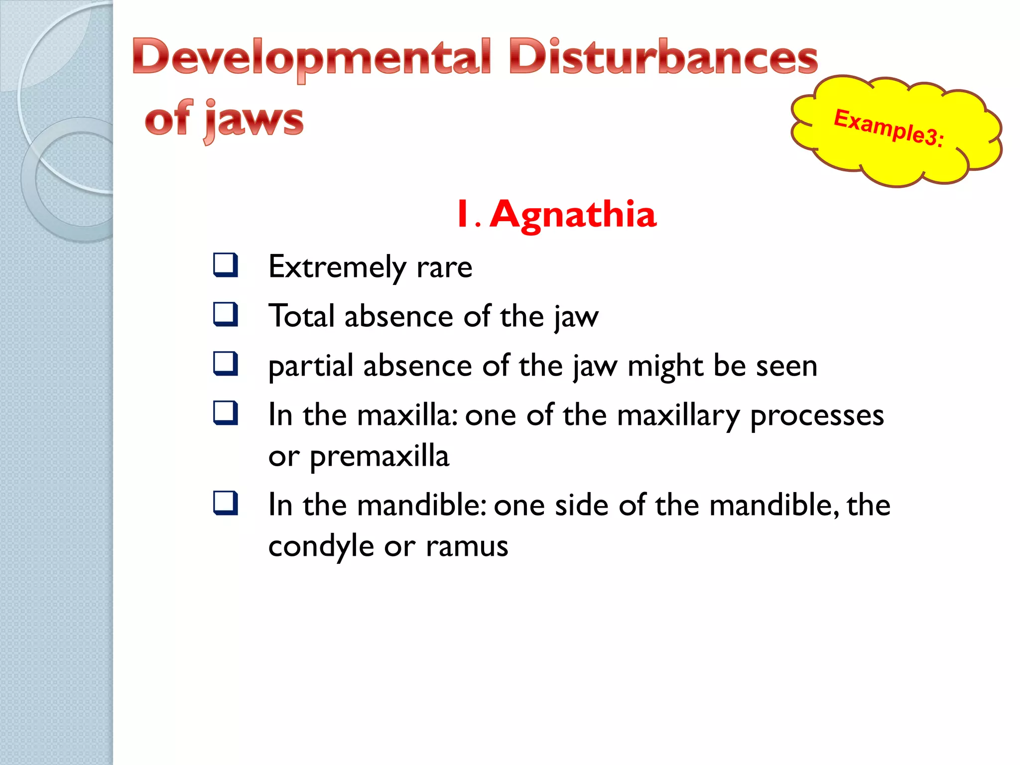 1. Agnathia
Extremely rare
Total absence of the jaw
partial absence of the jaw might be seen
In the maxilla: one of the maxillary processes
or premaxilla
 In the mandible: one side of the mandible, the
condyle or ramus





 