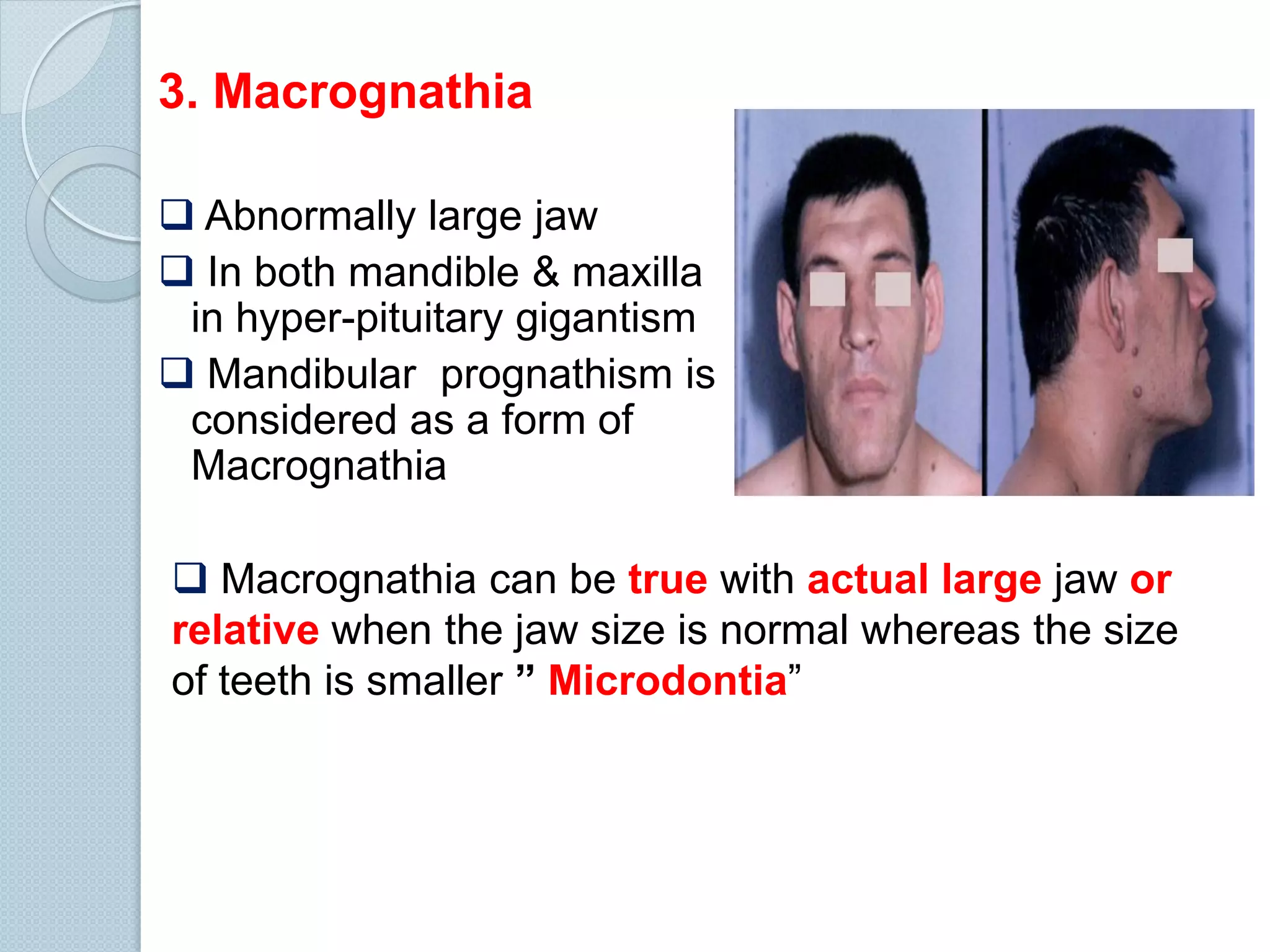3. Macrognathia
 Abnormally large jaw
 In both mandible & maxilla
in hyper-pituitary gigantism
 Mandibular prognathism is
considered as a form of
Macrognathia
 Macrognathia can be true with actual large jaw or
relative when the jaw size is normal whereas the size
of teeth is smaller ” Microdontia”

 