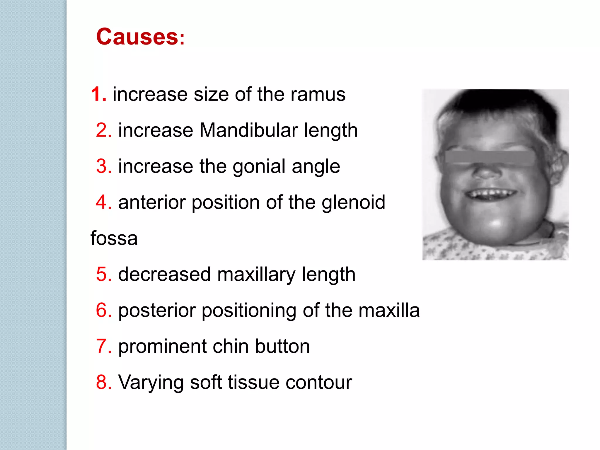 Causes:
1. increase size of the ramus
2. increase Mandibular length
3. increase the gonial angle
4. anterior position of the glenoid
fossa

5. decreased maxillary length
6. posterior positioning of the maxilla
7. prominent chin button
8. Varying soft tissue contour

 