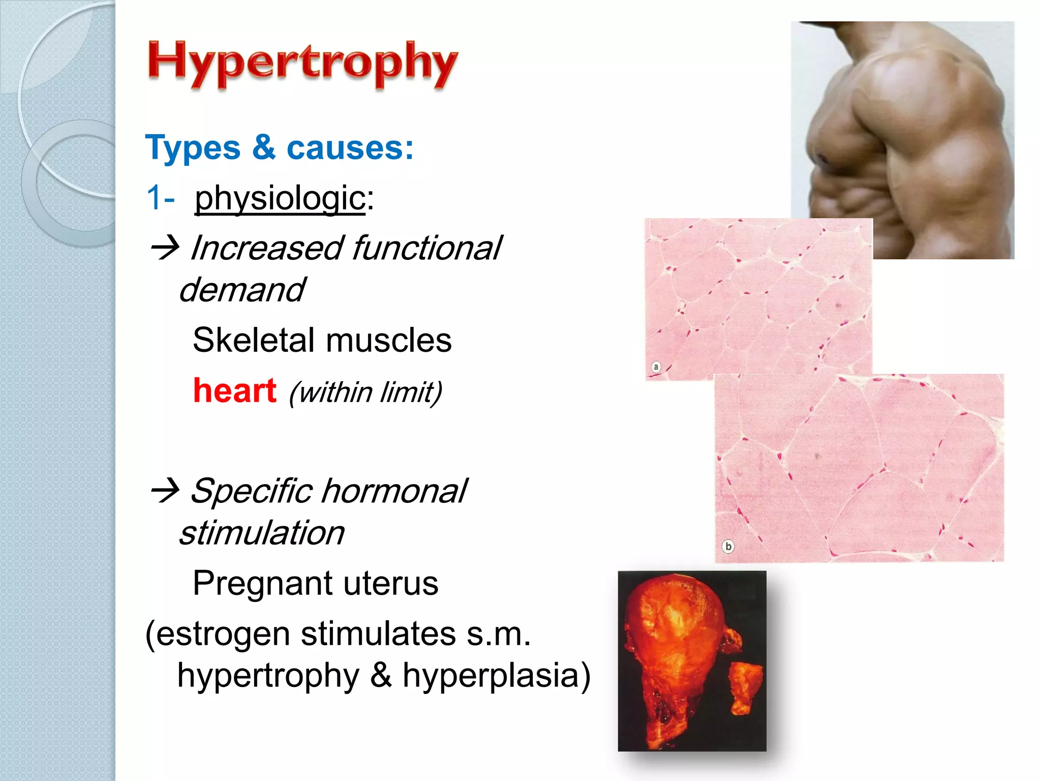 Types & causes:
1- physiologic:

 Increased functional
demand
Skeletal muscles
heart (within limit)

 Specific hormonal
stimulation
Pregnant uterus
(estrogen stimulates s.m.
hypertrophy & hyperplasia)

 