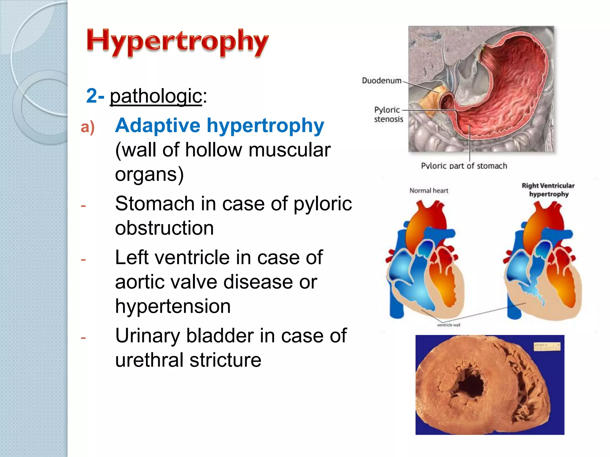 2- pathologic:
a) Adaptive hypertrophy
(wall of hollow muscular
organs)
Stomach in case of pyloric
obstruction
Left ventricle in case of
aortic valve disease or
hypertension
Urinary bladder in case of
urethral stricture

 