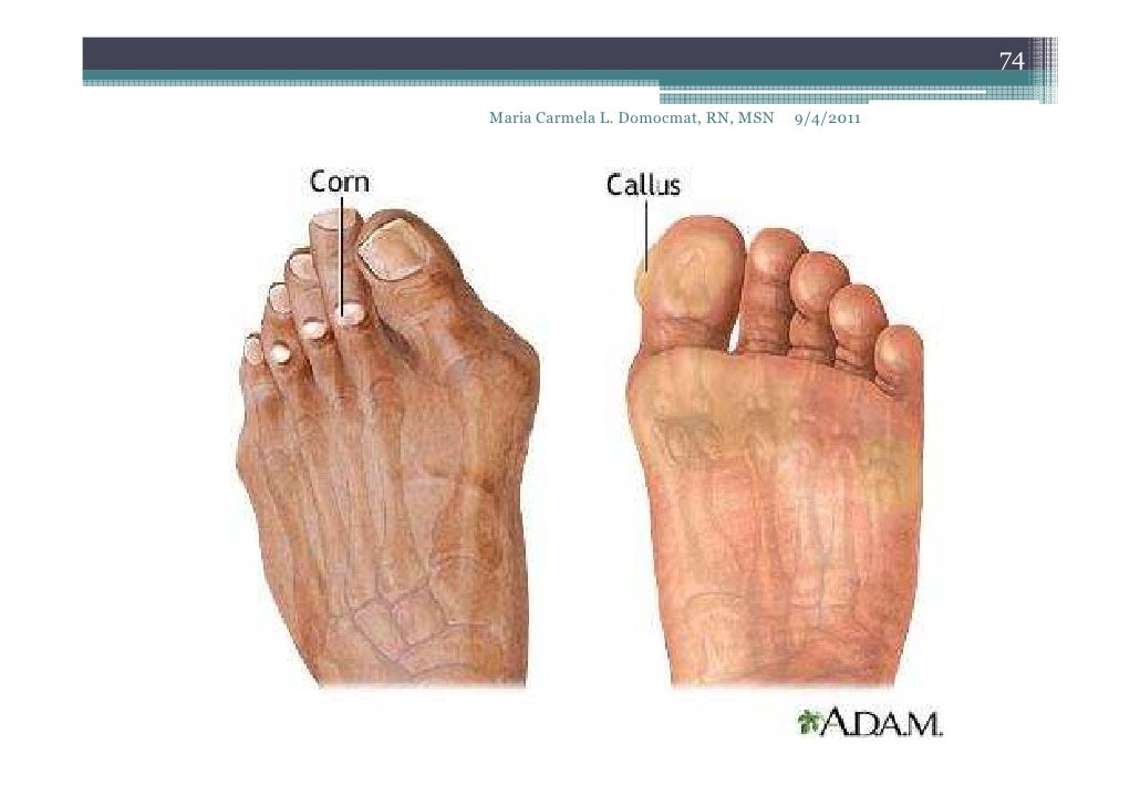 Disorders of hands and feet