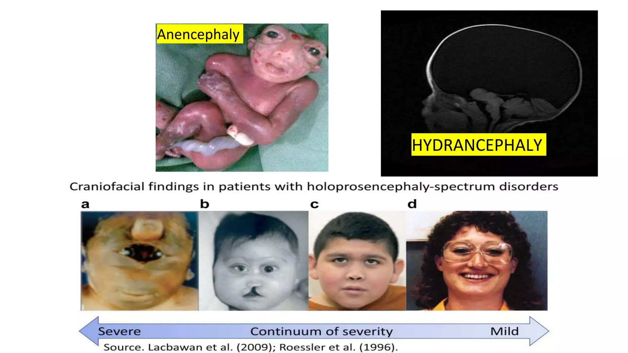 Anencephaly
HYDRANCEPHALY
 