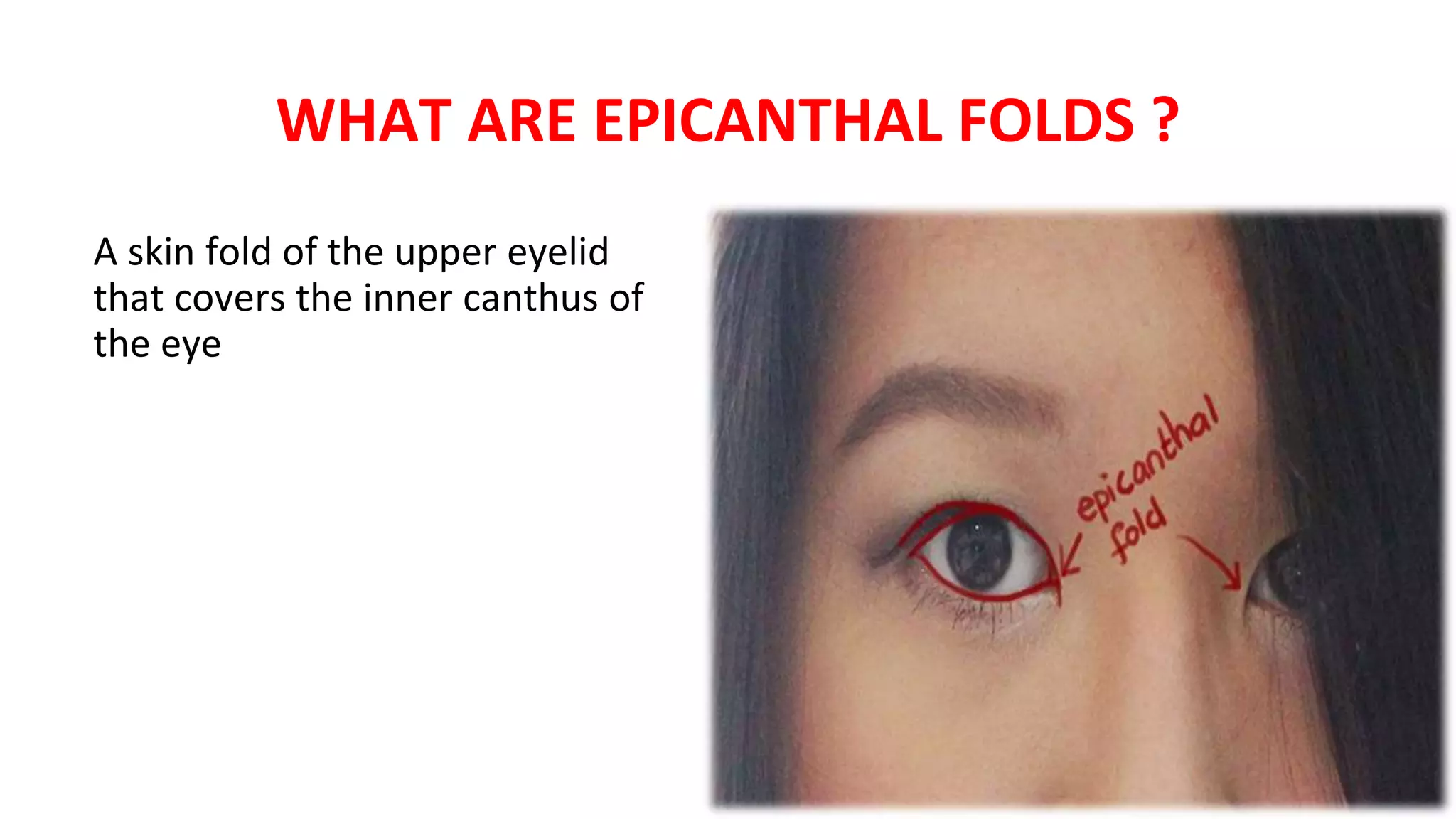 WHAT ARE EPICANTHAL FOLDS ?
A skin fold of the upper eyelid
that covers the inner canthus of
the eye
 