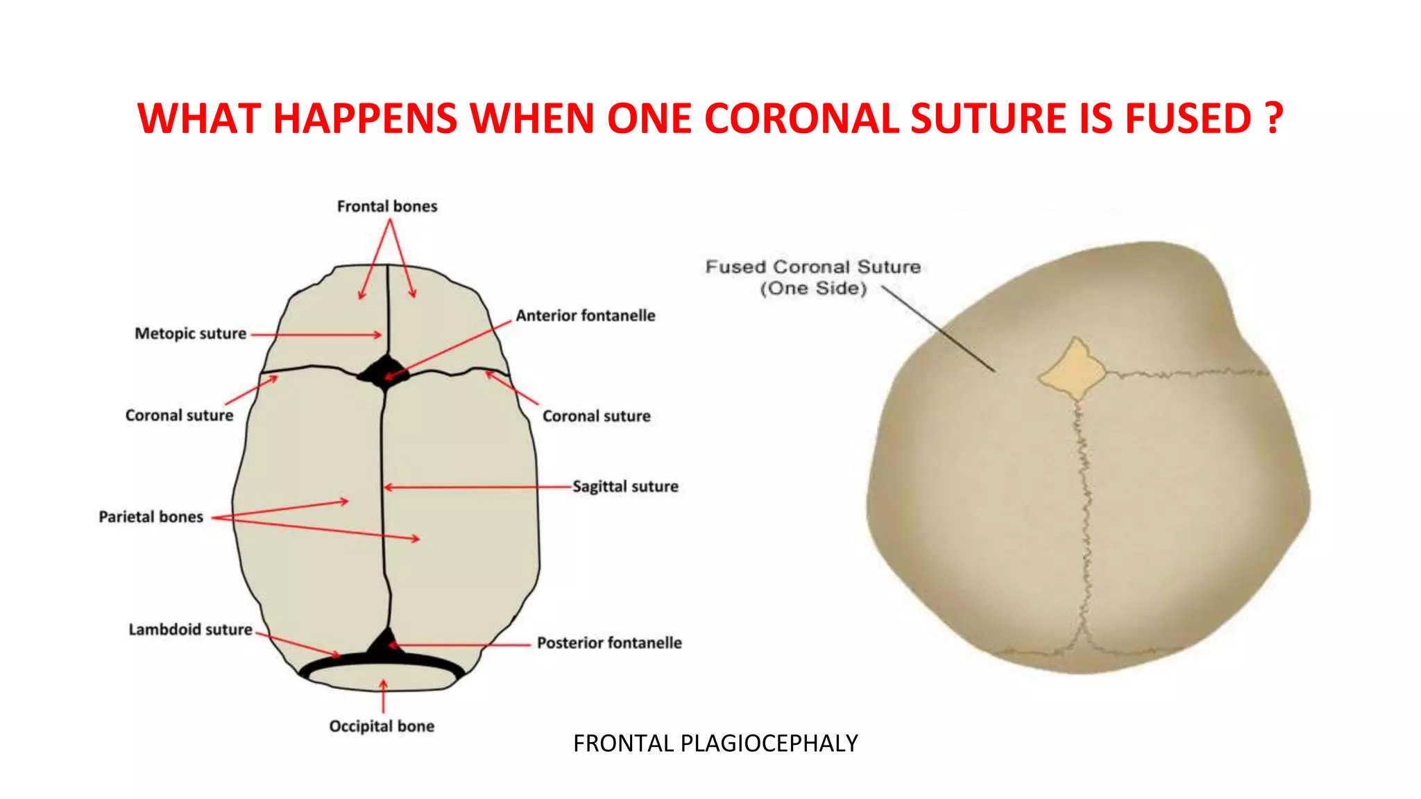 WHAT HAPPENS WHEN ONE CORONAL SUTURE IS FUSED ?
FRONTAL PLAGIOCEPHALY
 