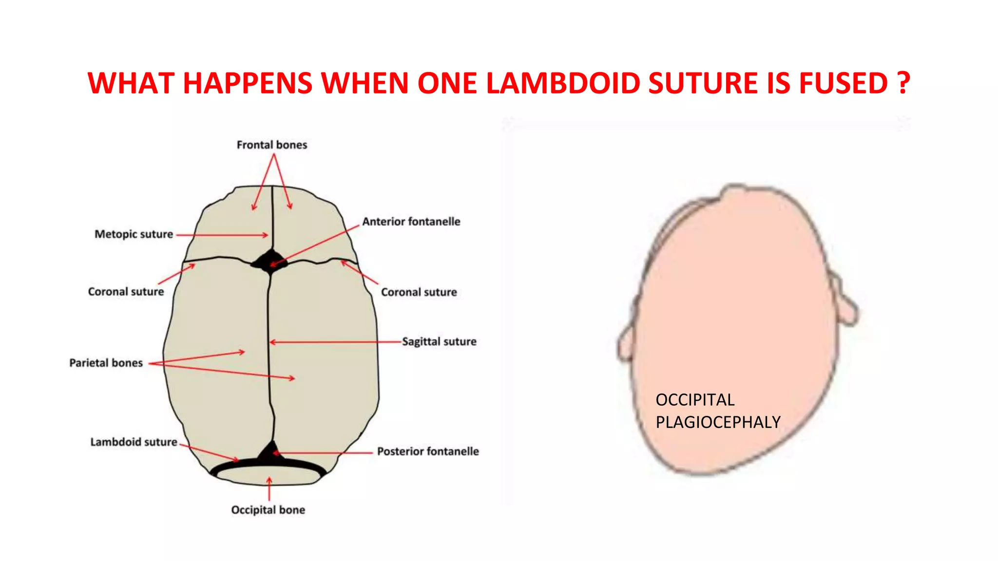 WHAT HAPPENS WHEN ONE LAMBDOID SUTURE IS FUSED ?
OCCIPITAL
PLAGIOCEPHALY
 