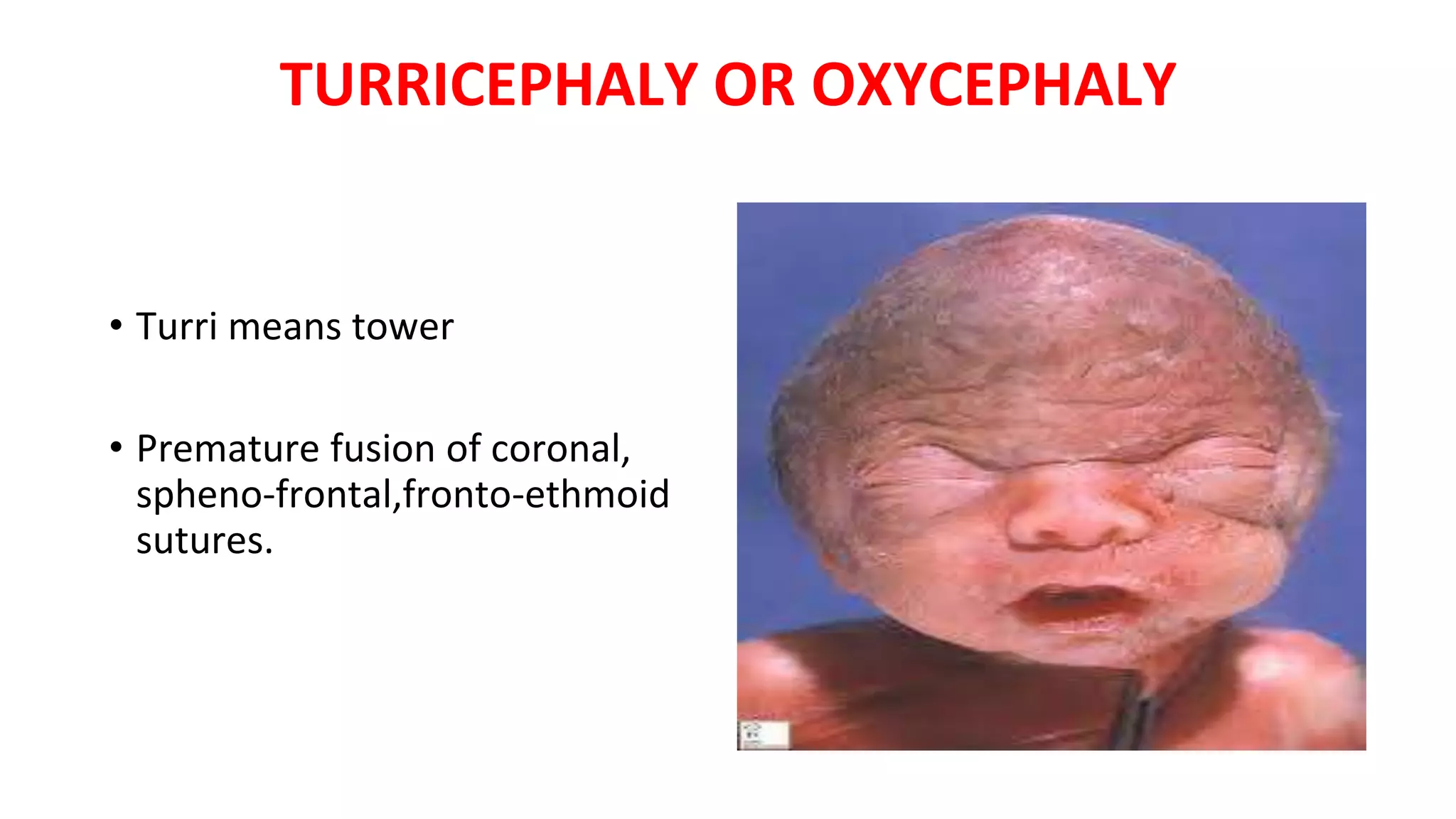 TURRICEPHALY OR OXYCEPHALY
• Turri means tower
• Premature fusion of coronal,
spheno-frontal,fronto-ethmoid
sutures.
 