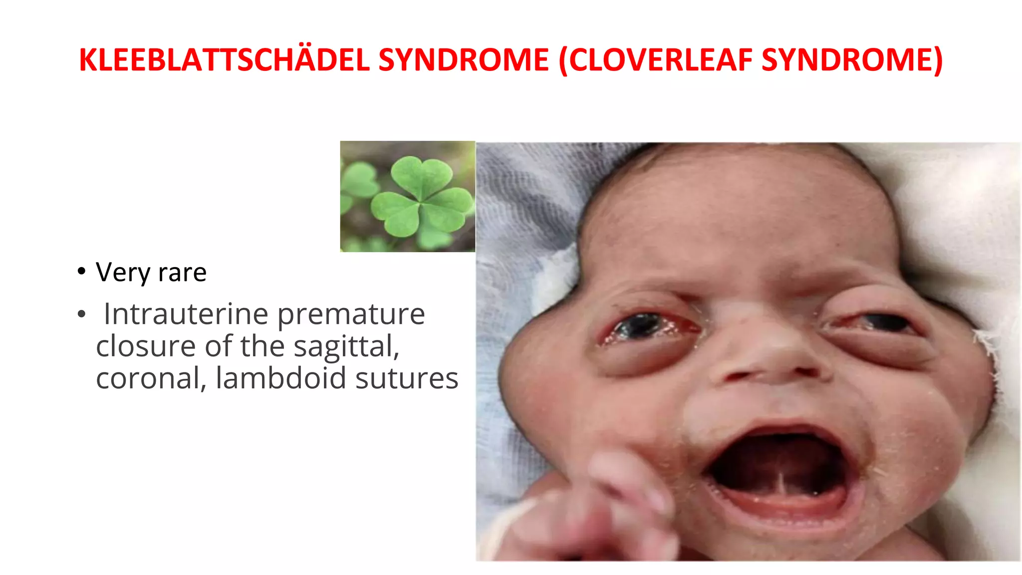 KLEEBLATTSCHÄDEL SYNDROME (CLOVERLEAF SYNDROME)
• Very rare
• Intrauterine premature
closure of the sagittal,
coronal, lambdoid sutures
 