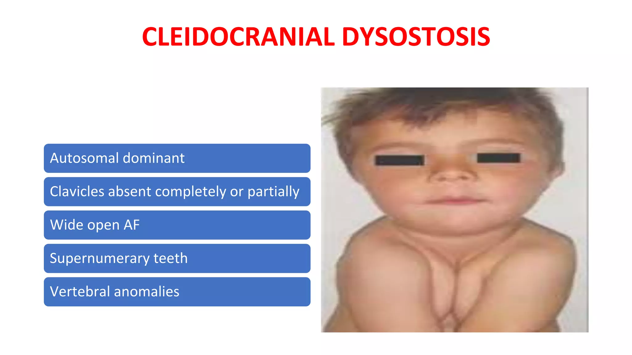 CLEIDOCRANIAL DYSOSTOSIS
Autosomal dominant
Clavicles absent completely or partially
Wide open AF
Supernumerary teeth
Vertebral anomalies
 