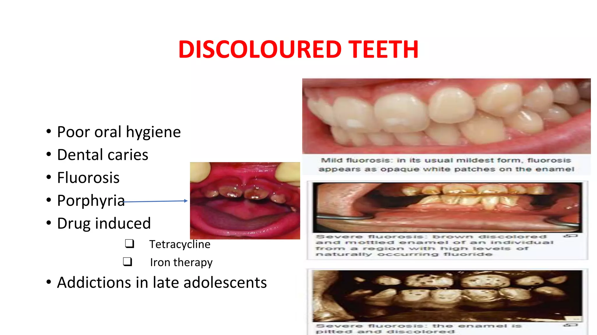 DISCOLOURED TEETH
• Poor oral hygiene
• Dental caries
• Fluorosis
• Porphyria
• Drug induced
❑ Tetracycline
❑ Iron therapy
• Addictions in late adolescents
 