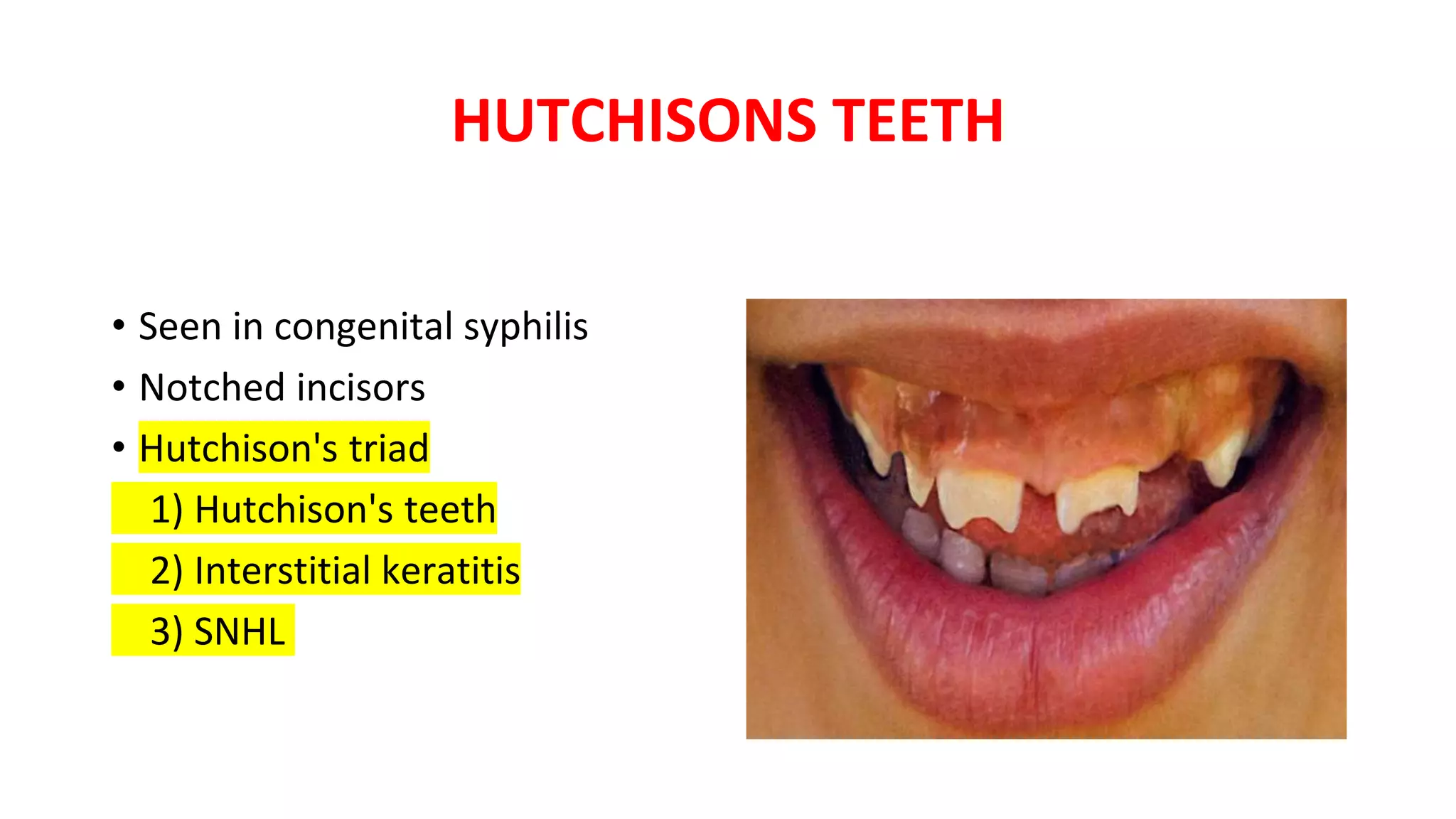 HUTCHISONS TEETH
• Seen in congenital syphilis
• Notched incisors
• Hutchison's triad
1) Hutchison's teeth
2) Interstitial keratitis
3) SNHL
 