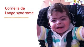 Cornelia de
Lange syndrome
 