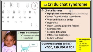 • Antimongoloid
slant
• Cat like cry
• Microcephaly
• MR
• FTT
 