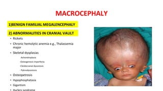 MACROCEPHALY
2) ABNORMALITIES IN CRANIAL VAULT
• Rickets
• Chronic hemolytic anemia e.g., Thalassemia
major
• Skeletal dysplasias
-Achondroplasia
-Osteogenesis imperfecta
-Cleidocranial dysostosis
- Pyknodysostosis
• Osteopetrosis
• Hypophosphatasia
• Gigantism
1)BENIGN FAMILIAL MEGALENCEPHALY
 
