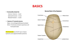 BASICS
• Fontanelles (total 6):-
Anterior, Posterior---1 each
Sphenoid Fontanel----2 each
Mastoid Fontanel-----2 each
▪ Sutures 17 named sutures
Major:-Coronal/Sagittal/Metopic/Lambdoid
Minor:-Frontonasal, temporo squamosal, and
frontosphenoidal
Third fontanelle b/w AF & PF seen in Downs
Syndrome and congenital Rubella syndrome.
 