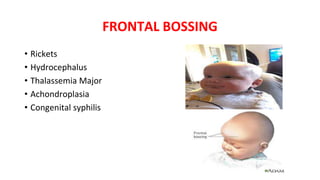 FRONTAL BOSSING
• Rickets
• Hydrocephalus
• Thalassemia Major
• Achondroplasia
• Congenital syphilis
 