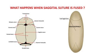 WHAT HAPPENS WHEN SAGGITAL SUTURE IS FUSED ?
DOLICOCEPHALY
 