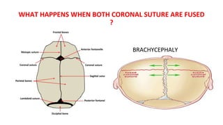 WHAT HAPPENS WHEN BOTH CORONAL SUTURE ARE FUSED
?
BRACHYCEPHALY
 