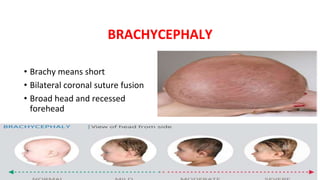 BRACHYCEPHALY
• Brachy means short
• Bilateral coronal suture fusion
• Broad head and recessed
forehead
 