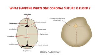 WHAT HAPPENS WHEN ONE CORONAL SUTURE IS FUSED ?
FRONTAL PLAGIOCEPHALY
 