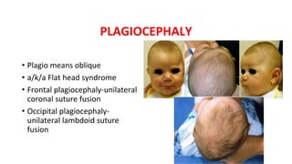 PLAGIOCEPHALY
• Plagio means oblique
• a/k/a Flat head syndrome
• Frontal plagiocephaly-unilateral
coronal suture fusion
• Occipital plagiocephaly-
unilateral lambdoid suture
fusion
 