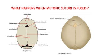 WHAT HAPPENS WHEN METOPIC SUTURE IS FUSED ?
TRIGONOCEPHALY
 