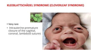 KLEEBLATTSCHÄDEL SYNDROME (CLOVERLEAF SYNDROME)
• Very rare
• Intrauterine premature
closure of the sagittal,
coronal, lambdoid sutures
 
