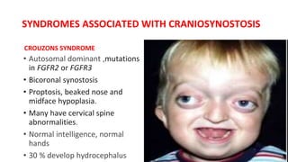SYNDROMES ASSOCIATED WITH CRANIOSYNOSTOSIS
CROUZONS SYNDROME
• Autosomal dominant ,mutations
in FGFR2 or FGFR3
• Bicoronal synostosis
• Proptosis, beaked nose and
midface hypoplasia.
• Many have cervical spine
abnormalities.
• Normal intelligence, normal
hands
• 30 % develop hydrocephalus
 