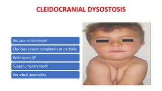 CLEIDOCRANIAL DYSOSTOSIS
Autosomal dominant
Clavicles absent completely or partially
Wide open AF
Supernumerary teeth
Vertebral anomalies
 
